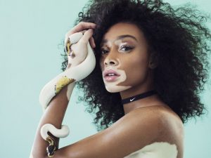 Read more about the article Winnie Harlow: From Cow to Top Model