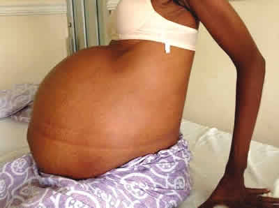 You are currently viewing Fibroids: The  Silent Burden